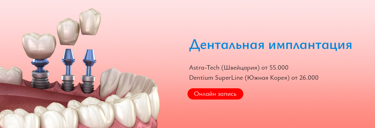 Дентальная Имплантация
